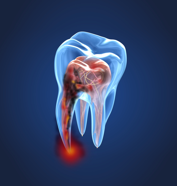 Endodontics & Tooth Restoration in Saratoga Springs, NY